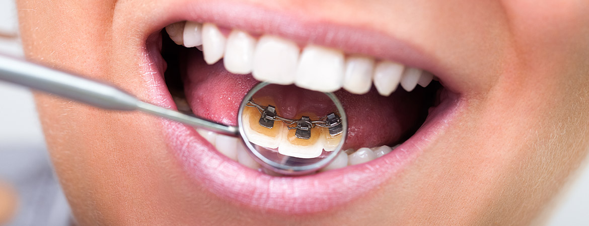 „unsichtbare“ Zahnspange in Gießen: die Innenzahnspange